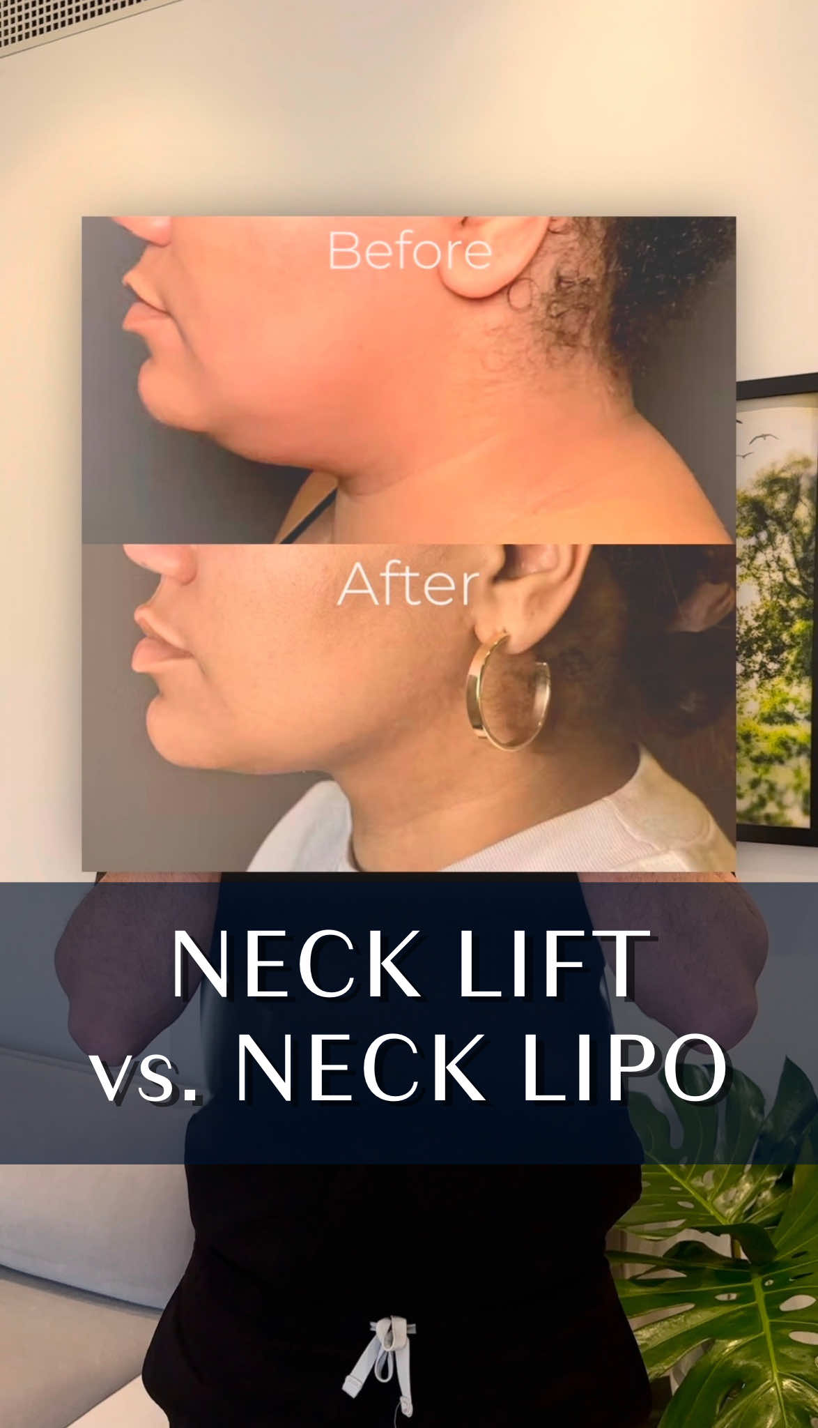 Different goals = different procedures 🌟 We have plenty of patients who come to us seeking a change in their necks. However, no two necks are the same, and sometimes require different approaches depending on your goals and anatomy. So, what’s the difference? Neck Liposuction ▶ Removes excess fat ▶ Sculpts and defines the jawline ▶ Best for younger skin with good elasticity Neck Lift ▶ Tightens loose skin and underlying muscles ▶ Smooths out sagging or “turkey neck” ▶ Ideal for more advanced signs of aging Want to explore your options? Don’t know where to start? Consult with us for free today! 📞 (212)-203-8623 💻 www.albertplasticsurgery.com 📍 950 Park Avenue, New York, NY  #necklift #neckliposuction #necklipo #nyc #plasticsurgery 