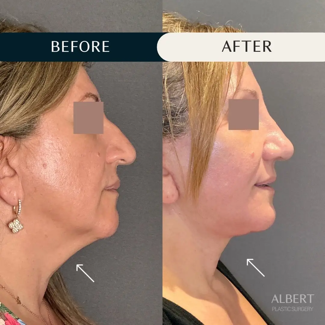 Starting Transformation Tuesday off strong with this fantastic facelift, neck lift, + facial fat transfer combo procure! She is only 3 weeks out and appears slightly swollen under her chin— which will subside in the next 1-2 months!  ▶ But WHY is combining procedures the BEST approach to plastic surgery? 👇🏻 For many, they fear the idea of looking “overdone”… but in my practice, that is never the case ❌ In this case, addressing all of this patient’s concerns actually allowed for a MORE comprehensive rejuvenation with results that look effortlessly natural and harmonious, yet effective and time-reversing. Patients also benefit from a single anesthesia and recovery period, making it both effective and efficient.  Ready to turn back time on your face? Consult with us today! 📞 (212)-203-8623 💻 www.albertplasticsurgery.com 📍 950 Park Avenue, New York, NY  #facelift #necklift #facialfattransfer #nyc #plasticsurgery  