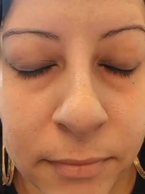 Bye Bye Dark Circles