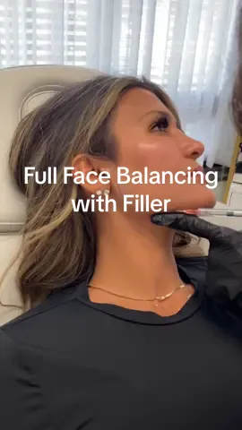 A little full facial balancing with HA filler with me. #dermalfillers #jawlinefiller #lipfiller #cheekfiller #npinjector 