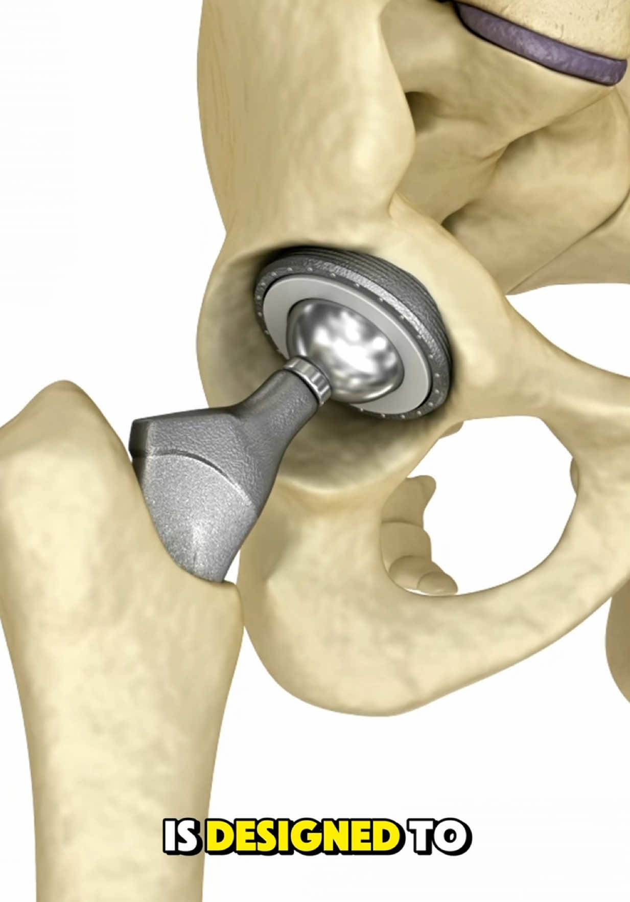 What happens in Hip replacement surgery? (3D Animation) #hipreplacements #hipreplacment #hipreplacementsuccess #hipreplacementsurgery #hipsurgery #hipjointsurgery #hiparthritis #medical3danimation #3dmedicalanimation 