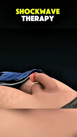 Shockwave therapy 3d animations. #shockwavetherapy #healthawareness #medicalanimation 