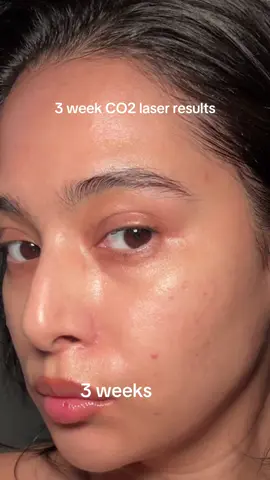 Week 3 CO2 laser results🫶🏽 #co2laserskinresurfacing #co2lasertreatment #co2laser #skintransformation 