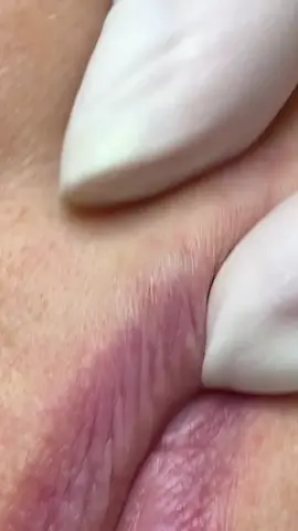 #pimple #viral #fly #satisfatório #asmr 
