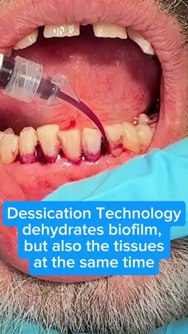 If your gums bleed, your dental hygienist may use dessication technology to gently dehydrate the harmful biofilm in your mouth, keeping it at low levels for up to 365 days! 🦷✨ This helps prevent gum disease and keeps your smile healthier year-round. #HealthyGums #DentalHygiene #GumHealth #OralCare #PreventGumDisease     