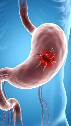 Your Stomach Pain Isn’t Normal – It Could Be an Ulcer! #healthtip #us #healthybody 