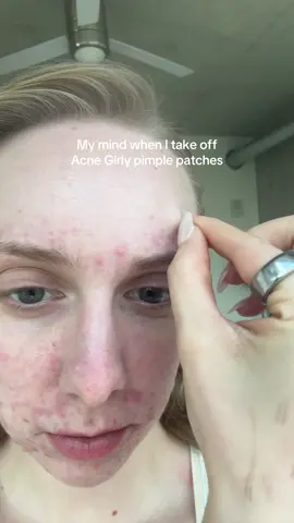 Lots of emotions throughout each peel 😭 #acne #pimplepatch #pimplepatches @Acne Girly 