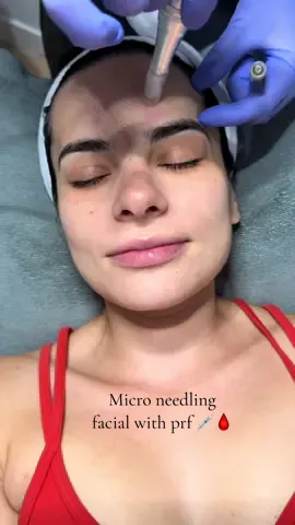 Micro needling facial with prf what keeps my skin youthful and healthy 🩸#microneedlingfacial #prf #skincare #facialtreatment 