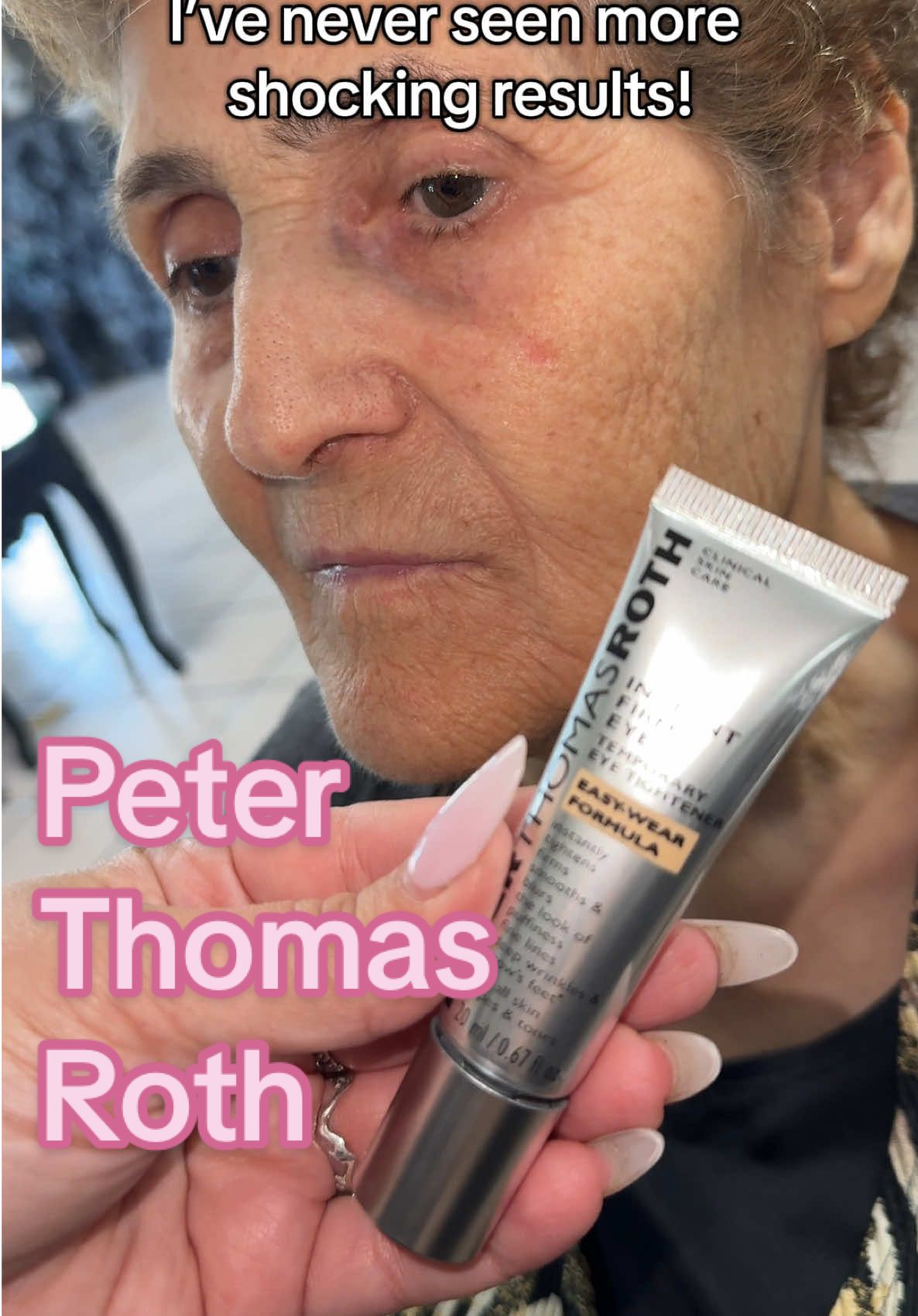 It’s back in stock and I just purchased one for my grandma!! Shocked is an understatement! This new formula is so much better than the old one, especially if you want to wear it with makeup! @Peter Thomas Roth Labs  🙌🏻 that is impressive! WOW. #peterthomasroth #instanteyelift #peterthomasrothinstantfirmeye #facelift #minifacelift #results 