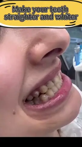 This cosmetic teeth cover changed my whole look in 30 seconds