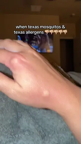everything’s bigger in texas 🦟🥲 #texas #tx #mosquitos 