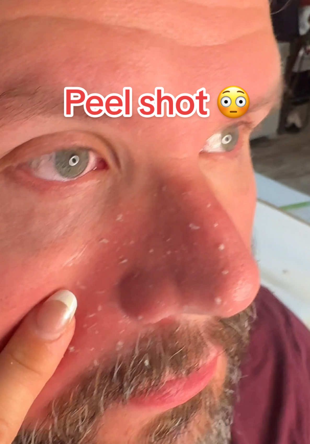 OMG this stuff work for black heads! @Dr.Melaxin Global #drmelaxin #peelshot #blackhead #tiktokshopcreatorpicks #tiktokmademebuyit 
