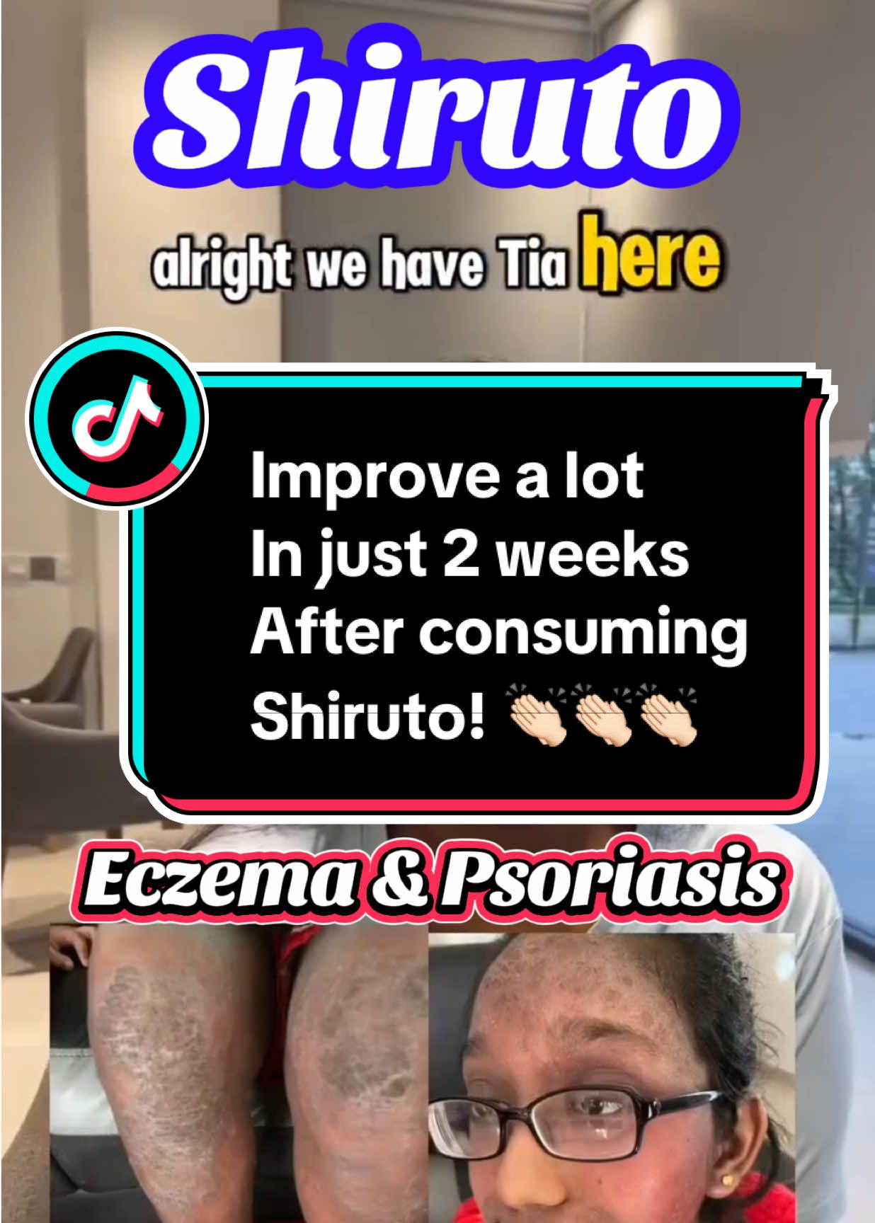 #shiruto #immunesystem #eczema #psoriasis #skin  ✨ From Pain to Healing ✨Struggled with eczema and psoriasis for years — dealing with constant itchiness, flare-ups, and emotional stress. But after consistently taking Shiruto, Aulora socks, and Spirulina, the changes were truly remarkable 🌿✅ Skin no longer inflamed✅ Confidence slowly restored✅ Healing from the inside out — naturally and safelyThis is more than just skincare or supplements. It’s about giving the body what it needs to protect, repair, and thrive.If you or someone you love is going through a similar journey, know that healing is possible. 