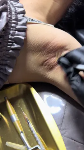 Nách thâm sạm đen, peel 1 lần cải thiện độ thâm 70% lun ạ😆😆 tin dc khum hihi  Peel nách không đau không buốt khử thâm nách lâu năm hay bẩm sinh hoặc do nhổ nhiều lần🙄 PHUN XĂM THẨM MỸ    