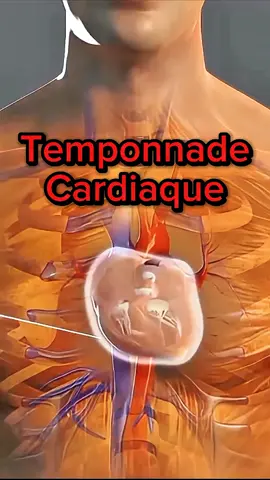 On parle de tamponnade cardiaque  lorsque l'épanchement péricardique génère une pression suffisante pour comprimer les cavités cardiaques et être responsable d'une insuffisance circulatoire aiguë. #medical #coeur #pression #santé #kathfibro 