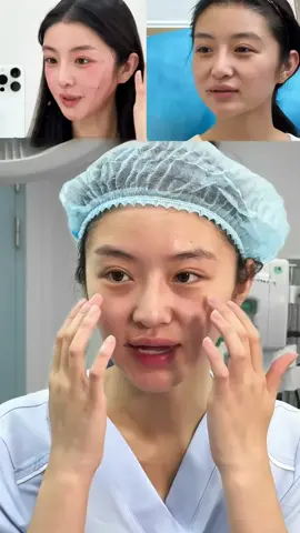 Facelift #PlasticSurgery #BeforeAndAfter #facelift #CosmeticSurgery 