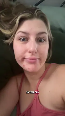 Almost 100k views on a video of my cystic hormonal acne, yay😵‍💫 #unhinged #hormonalacne #cysticacne #acnetreatment #acnejourney 