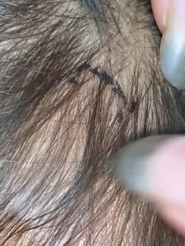 😨😨😨 #lice #omg #liceremove 