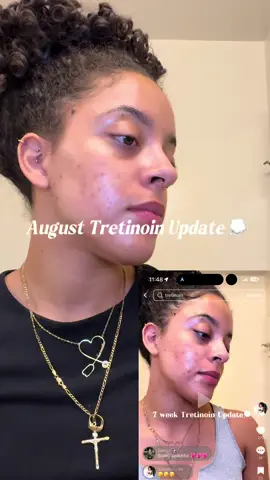 Skin update - August check in!!! 🥹🤍  Products used: @Bubble Skincare cosmic silky toner and cloud surf moisturizer Azelaic Acid 15% @The INKEY List exosome hydro glow complex serum  @Kiehl's Since 1851 avocados eye cream @byoma ultralight face fluid spf 50  #tretinoinjourney #azelaicacid #skincareroutine #acneproneskin #cysticacne #fypシ #tretinoin #hormonalacne #morningskincare #CapCut #goodmorning #morningroutine 
