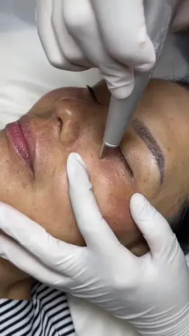 Combo trị nám +xử lí luôn mụn thịt và quầng thâm mắt lâu năm !!! #oanh_chuyên_trị_nám #điều_trị_nám #tăng_sắc_tố_da #chuyên_giải_quyết_các_vấn_đề_về_da #laser_Co2_trị_Nám #trị_nám_tàn_nhang #điều_trị_nám_tàn_nhang 
