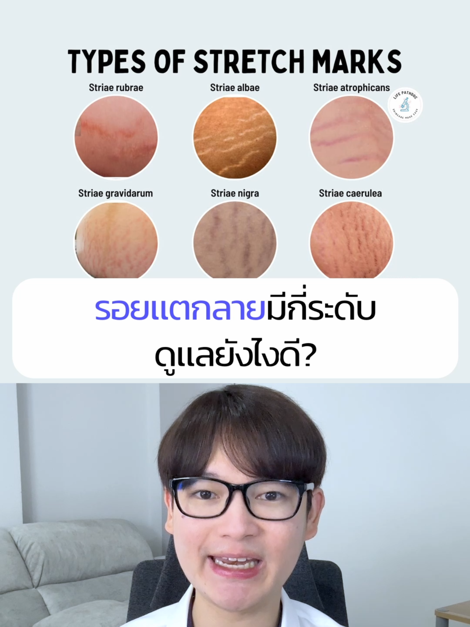 รอยแตกลายมีกี่ระดับ ดูแลยังไงดี #รอยแตกลาย #ดูแลผิว #ขาลาย #รอยแตกหลังคลอด #ช้อปติดเทรนด์ #khonchon