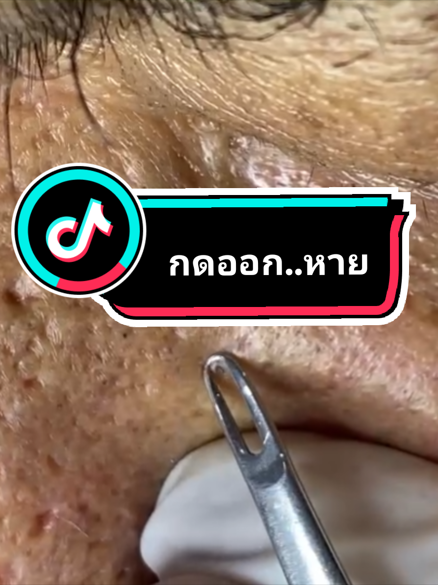 #พี่กุ้งกดสิว กดสิวออกสุดด้วย #เทคนิคพี่กุ้งกดสิว พร้อม #สอนดูผิว #สิว #กดสิวอุดตัน ออกได้หายสิว