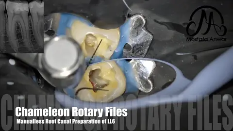 #AnwarEndo  Chameleon Rotary Files for Manualless Root Canal Preparation in Lower First Molar with Obliterated Mesial Canals and Apical third of Distals having Slight abrupt curvature at the last 3 mm…