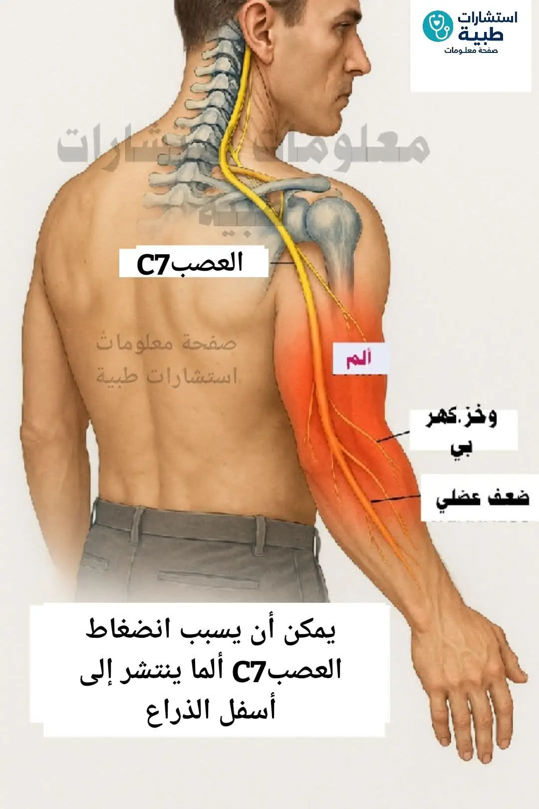 💥استشارات المتابعين عن الم الرقبة والعصب العنقي اجوبة شاملة لكل سؤال ............... ❗السؤال 1  هل انضغاط العصب في الفقرات العنقيه يمكن يسبب الم ينتشر للذراع. جواب؟  نعم يسبب الم يبدا من الرقبه يمتد للكتف والذراع ولحد الاصابع ....... ❗السؤال 2 اي اصابع ممكن تتاثر جواب؟  حسب الفقره C6 ياثر على الابهام والسبابه C7 ياثر على الوسطى C8 ياثر على البنصر والخنصر ..... ❗السؤال 3 ما الاعراض غير الالم جواب؟  تنمل وخدر ووخز مثل كهرباء وضعف في اليد ..... ❗السؤال 4 كيف أميز؟ بين انضغاط العصب والشد العضلي جواب؟  الشد العضلي يخف خلال ايام وما يسبب تنمل وضعف اما انضغاط العصب يرافقه خدر وتنمل وضعف ...... ❗السؤال 5 هل الحاله يمكن علاجها جواب؟  اغلب الاحيان تتحسن بالدواء والعلاج الطبيعي والتمارين ونادر تحتاج جراحه ...... ❗السؤال 6 ما التمارين الي تساعد جواب؟  تمارين مط للرقبه وتقويه للعضلات المحيطه.منتشرة على السوشل ميديا ؟؟وجلوس صحيح والافضل تحت اشراف مختص ...... ❗السؤال 7 هل الحقنه تعالج الحاله نهائيا جواب؟  الحقنه تهدي الالم وقتي لكنها لا تعالج السبب ..... ❗السؤال 8 اي فقره اكثر تسبب المشكله جواب؟  الاكثر C5 C6 C7؟؟ ........ ❗سؤال 9 كيف اعرف اي فقرة مصابة جواب؟  اذا العصب C5 يتاثر الكتف وضعف برفع الذراع؟؟ اذا العصب C6 يتاثر الابهام والسبابة مع ألم وضعف بالعضلة ذات الراسين biceps؟؟  اذا العصب C7 يتاثر الاصبع الوسطى مع ضعف بمد الكوع .وعضلة triceps؟؟ ...... ❗السؤال 10 متى ازور دكتور بسرعه جواب؟  اذا ضعف شديد باليد فقدان احساس او فقدان سيطره على البول والبراز ...... ❗السؤال 11 هل الجلوس الطويل على الموبايل والكمبيوتر يزيد المشكله جواب؟  نعم الوضعيات الغلط اهم سبب ..........  عندك سؤال عن الم الرقبة او تنميل اليدين اكتب تعليقك وسنجيبك شارك المنشور مع اصدقائك ليستفيدوا  شاركنا تجربتك  ندعمكم بالمعلومة ولانسالكم الا الدعاء 🙏 ✍️ Dr Komel #Komel #alm_rqbh #3lag_tb3y #tmaryn #TikTok 