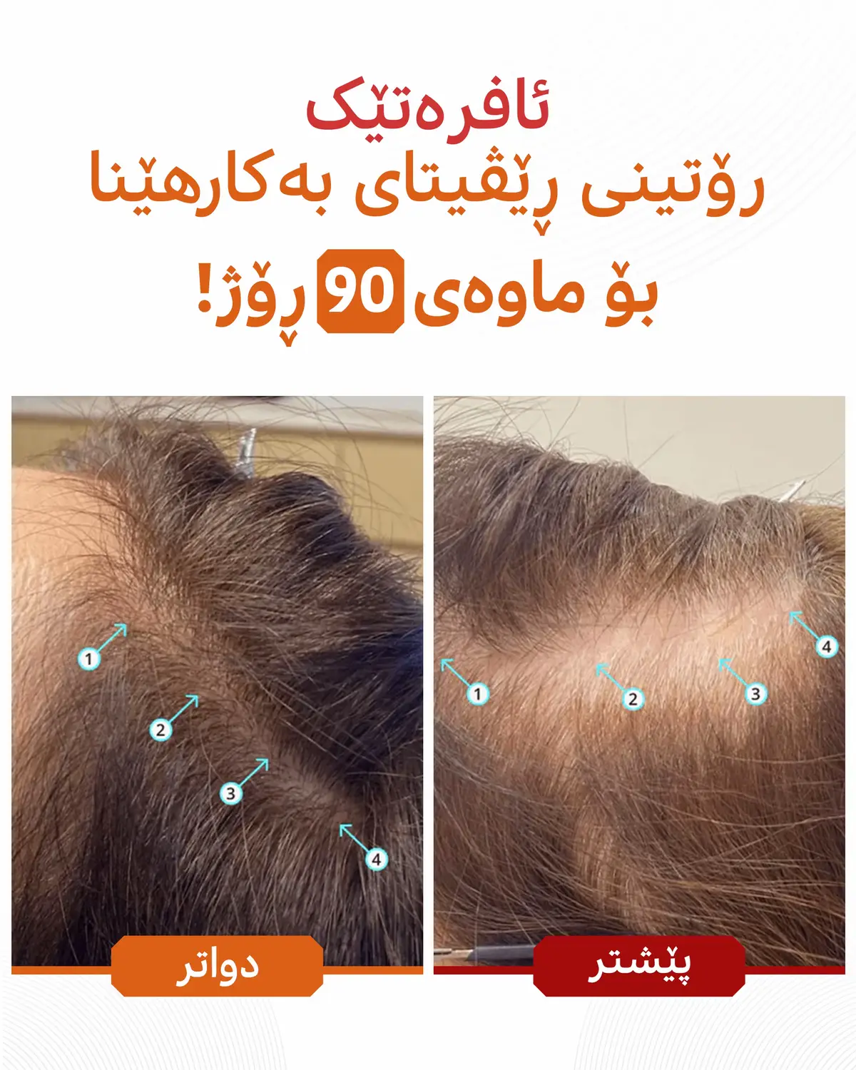 ئەنجامەکان خۆیان دەدوێن 👌 ئەم خاتوونە قژی چڕ و پڕ و تەندروستتر بوو دوای تەنها 90 ڕۆژ لە بەکارهێنانی ڕۆتینی ڕێڤیتا کە بریتیین لە: 1️⃣ شامپۆی ڕێڤیتا 2️⃣ کۆندیشنەری ڕێڤیتا 3️⃣ سیرۆمی Spectral تایبەت بە ئافرەتان شامپۆی ڕێڤیتا بەرهەمێکی DS Labsی ئەمریکییە کە: ✅ نوێترین تەکنەلۆژیای نانۆسۆمی تێدا بەکارهاتووە ✅ کاریگەرییەکانی بەتوێژینەوەی زانستیی سەلمێنراوە ✅ سەلامەتە بۆ بەکارهێنانی ڕۆژانە ئێستا بەردەستن لە کوردستان، داوای بکە و یەک کێشەی قژت نامێنێت #قژ #هەڵوەرین #قژ_هەڵوەرین #شامپۆ #ئەمریکی #کوردستان #DSLabs #DSLabs_KRD #رێڤیتا