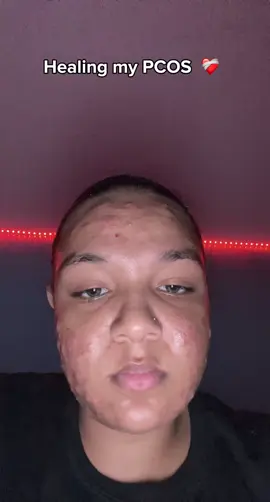 PCOS WARRIOR❤️‍🩹|| having PCOS can be every day battle. I was diagnosed with PCOS at the age of 14. My first symptom was missing periods and cramping. Then came the cystic acne in weight gain. I am now 24 and I still struggle with PCOS, but with hard work you will prevail. if you want more videos about PCOS  and my journey please drop a “❤️‍🩹” in the comments! I have learned so much about PCOS over the years❤️ #fyp #pcos #pcosawareness #pcosacne #pcostreatment 