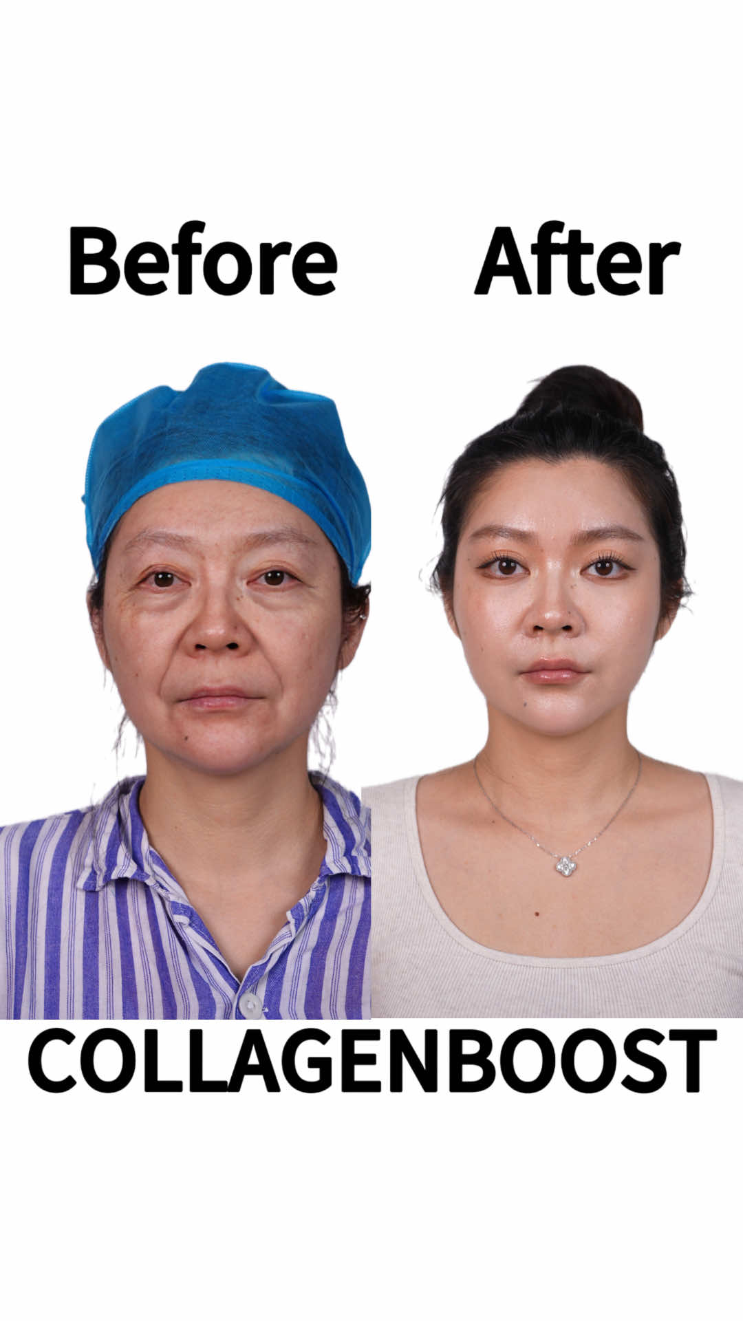 Sagging skin OFF ❌ Youthful glow ON ✅ 拉皮，專治「鬆弛感」 ใบหน้าดูอ่อนเยาว์อีกครั้ง Percaya diri kembali 100% #FaceliftProven #拉皮逆龄 #焕新自我 #抗衰提拉 #年轻魔法
