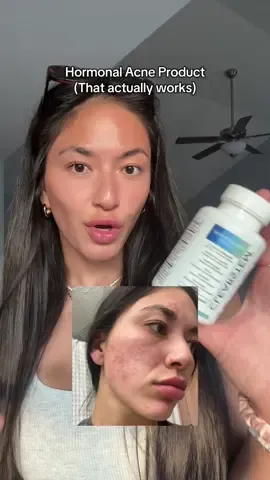 Hormonal acne in late 20s is no joke 😭 thankful to find @CLEARSTEM Skincare , it actuallly works & bought so many bottles of this before ever posting about it 💛🙏🏼 #hormonalacne #hormonalacnejourney #acneproducts #hormonalbalance #acnesafe 