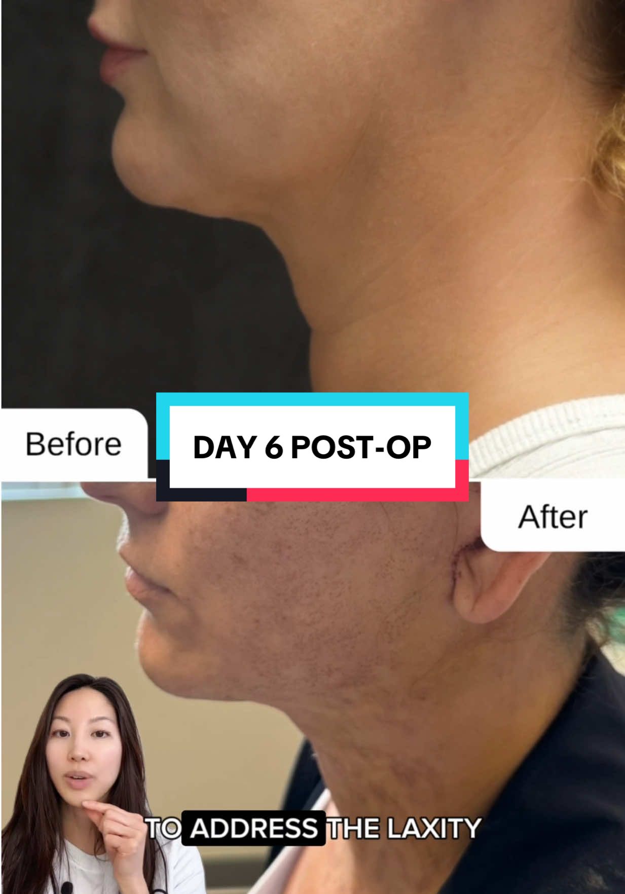 This is my beautiful patient after the following procedures: ✅ deep plane facelift ✅ neck lift ✅ browlift ✅ blepharoplasty ✅ co2 laser ✅ fat grafting Here she is only day 6 post-op and I can’t wait to share her journey with you all!✨ #plasticsurgeon #plasticsurgery #facelift #necklift #BeautyTok #surgery #surgerytiktok 