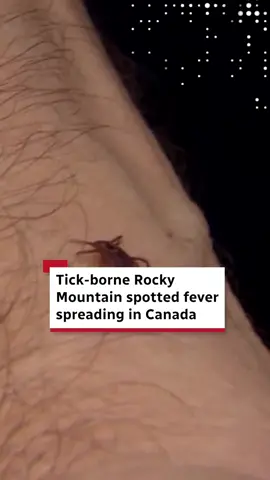 Rocky Mountain spotted fever is named for the red rash that develops two to four days after the fever begins, which can range from pinpoint dots to red splotches. The disease can be treated with the common antibiotic doxycycline, and most people make a full recovery. #Tick #Fever #Canada #Moment #CBCNews 