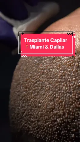 Trasplante Capilar Miami & Dallas Consulta de evaluación Gratuita y Online #TrasplanteCapilar #care4hair #miami #alopecia #hairtransplant 
