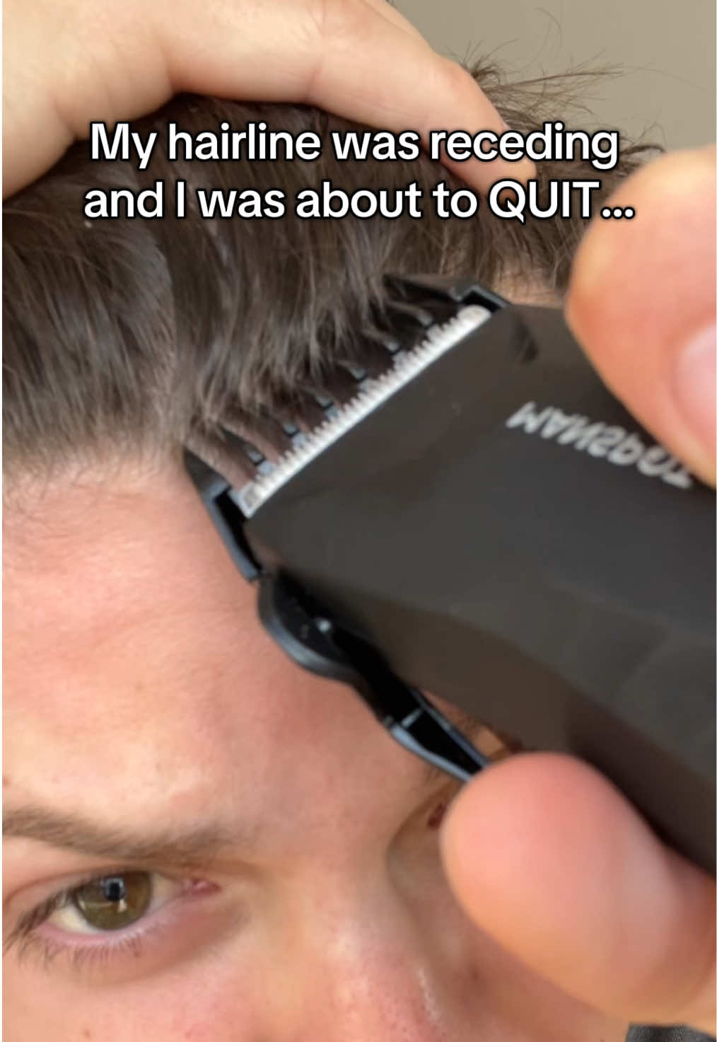 if only I found out about this sooner #bebodywise #hairgrowthserum #balding #men #hairloss