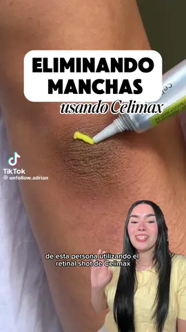 COMENTA LA PALABRA “LINK”🔗🔗🔗 y te lo mando a tu DM 💘✨ ¿Sabías que también puedes usar retinal en los codos? 👀 . Hasta ahora lo hemos probado en líneas de expresión en la frente, poros y ahora en los codos!! ✨💘  Este producto ha sido un 10/10 ⭐️⭐️⭐️⭐️⭐️ @celimax.global  #celimax #retinal #manchasenlapiel #skincarecoreano 