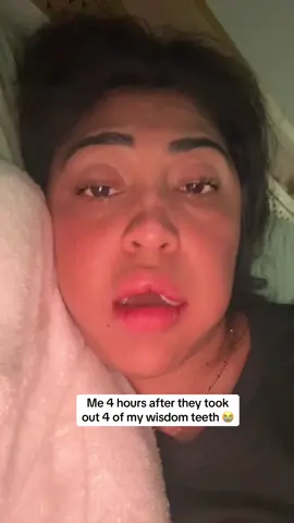 #wisdomteeth #wisdomteethremoval #painful #foryou #parati 