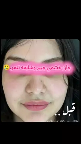 رايده خشم صغير بدون عمليات؟  الحل الوحيد هو سيروم وقالب لتصغير الانف.  #تصغير_الانف #اكسبلور #fyp #انف #خشم 