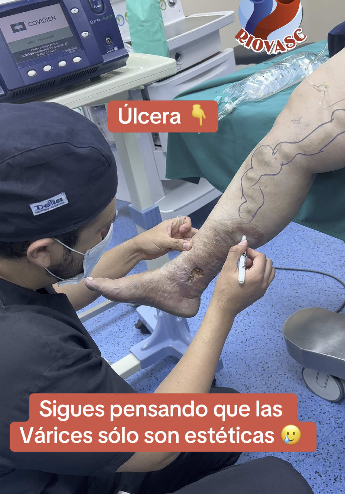 🏩 Las Várices constituyen un serio problema de salud 😱👆pueden llevarte a Úlceras Varicosas, Trombosis, etc 🥹 Siwmprw visita a un Especialista @The Vein Doctor 👨‍⚕️ 👉 Riovasc 👈📲+593995178395/+593958757917 #ulceravaricosa #varices #varicesenlaspiernas #venasvarices #varicesyarañitas #arañasvasculares #paratii #parami #cirugiavascular #cristianbravo148 