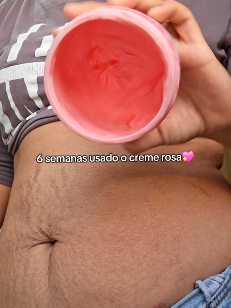 6 semanas usando o creme que mudou minha autoestima 😍💖 #lipedema #celulite #foliculite #estria #adeusfoliculite #adeusestria #adeuslipedema #adeuscelulite #cremerosa #gorduralocalizada #posparto #corpoposparto #cremerosa #autocuidado #foryou #foryoupage #estriasbrancas  #cuidadoscomapele #autocuidadofeminino