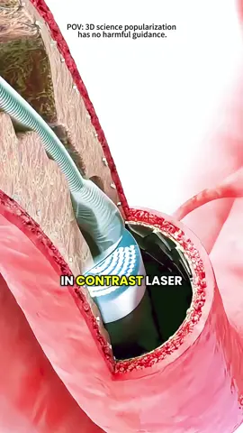 Laser Atherectomy (3D Animation) #laser #atherectomy #laseratherectomy #angioplasty #ballon #artery #catheter #ultravoilet #vaporize #calcified #blood #medical3danimation #3dmedicalanimation