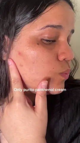 Miren los cambios en 7 días con mi crema de @PURITO SEOUL  #purito #panthenolcream #koreanskincare #glowcream #glowingskin #skincareroutine #viralmoisturizer #viralcream #skintok #healthyglow