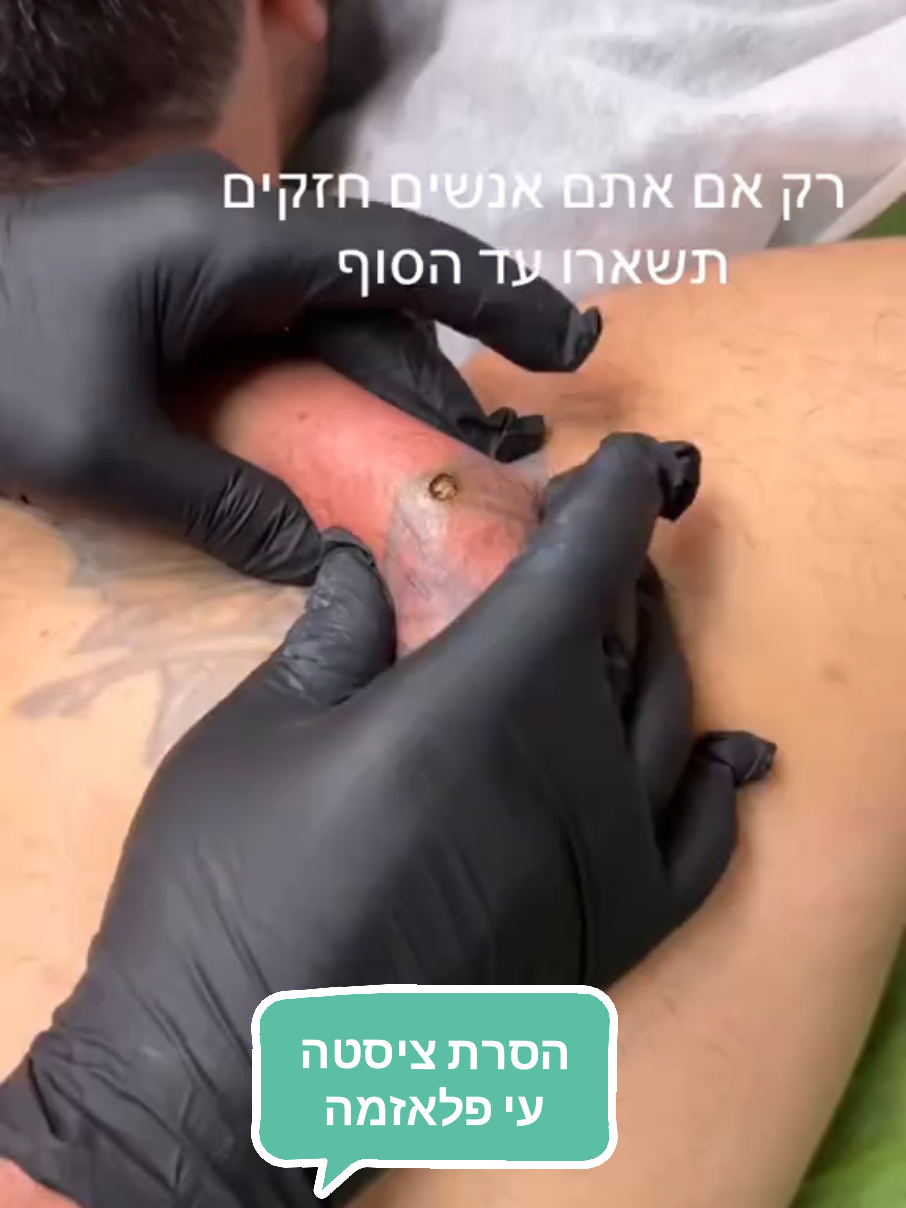 #דנהלימורהקוסמות #פלאזמהמשולבת #קורסיםוהשתלמויות #ציסטה #0506700052 