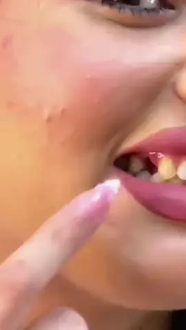 La falta de dientes ahora en realidad se puede usar pegamento dental temporal para reparar los dientes, la falta de dientes, la caries dental y la reposición dental.#dentadura #filling #teeth #toothless #tooth 