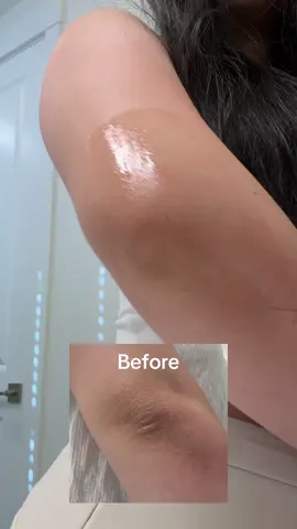 Just tried the SKIN1004 Madagascar Centella Retinol 0.2 Boosting Shot Ampoule 30ml ✨ Lightweight, absorbs fast, and super gentle 🌿 💛 I even tested it on my elbow. Smoother skin in just 7 days = real retinol glow up! You will see better results the longer you use it. ✨ Key points: 	•	Brightening + anti-wrinkle effect 	•	Gentle but effective 	•	Spicules for better absorption 	•	Visible results in about a week You can grab SKIN1004 on the Official Website or YesStyle 🛒 Use my code 👉 01CHIUJIAA 👈 for extra savings 🎉 Thank you @SKIN1004 US  & @BAZZAAL for this SKIN1004 Madagascar Centella Retinol 0.2 Boosting Shot Ampoule 30ml. #spicule #spiculeampoule #centella #centellaskincare #skincare    