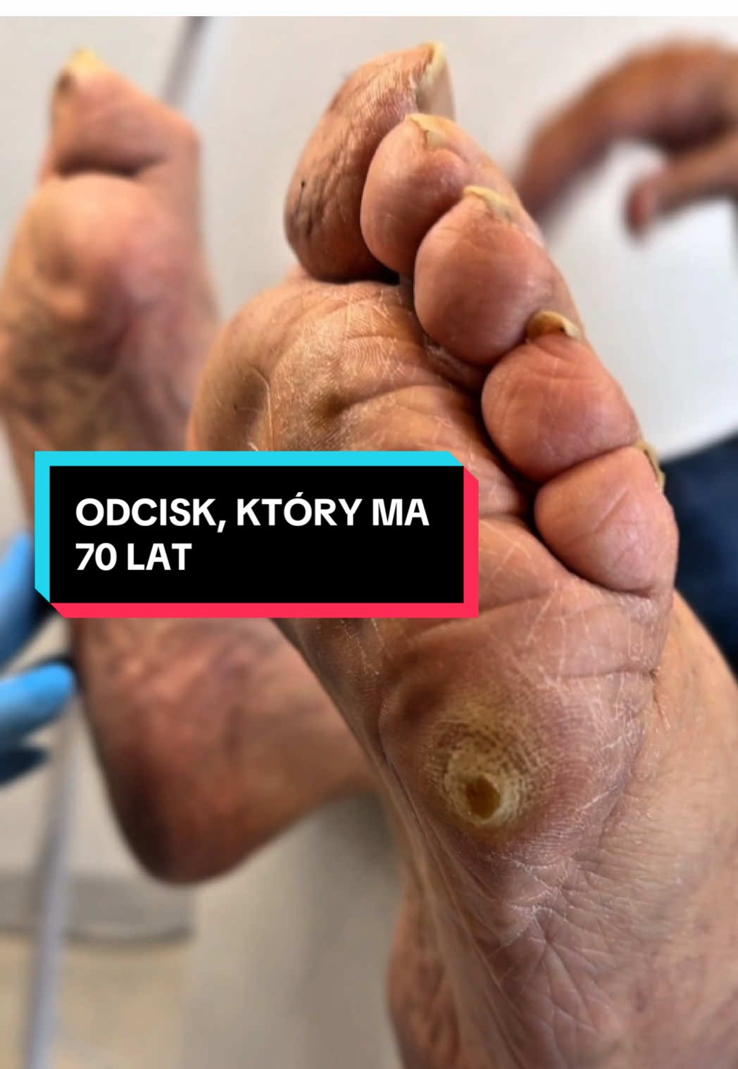 Ten odcisk towarzyszył pacjentowi przez większość życia – prawie 70 lat 👣 Podczas wizyty dokładnie go opracowałam. Do pielęgnacji domowej zalecam maść Peclavus z propolisem. 👉 Pamiętaj, że żaden preparat nie zastąpi pracy podologa, ale może skutecznie wspierać efekty zabiegów. Ten produkt jest dostępny w naszym sklepie internetowym 👉 sklep.podologiagdansk.pl ➡️ Zadbaj o swoje stopy – umów wizytę w naszym Centrum Podologii : 📲 +48 899 600 650 📩 recepcja@podologiagdansk.pl Albo przez Booksy (LINK w BIO) #reklama #autopromocja #podolog #podologia #Trójmiasto  