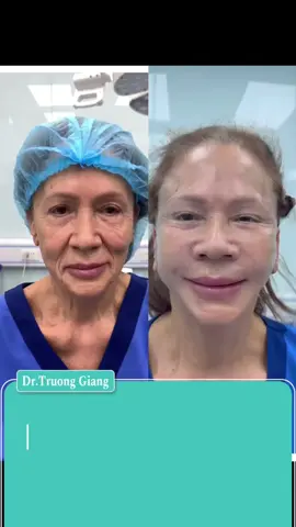 Căng da mặt giúp lấy lại thanh xuân #xuhuong #pttm #căngdamặt #viral 