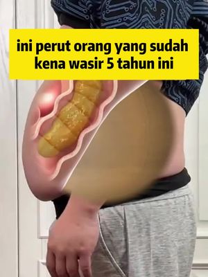 Wasir sering terjadi, Anda benar-benar dapat mencobanya