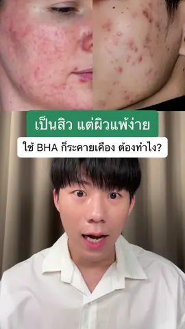 เป็นสิว ผิวแพ้ง่าย ใช้ BHA ไม่ได้ อยากจัดการสิวแบบอ่อนโยน ต้องลอง YVES ROCHER SEBO ACTIVE CLEAR⭐️ #SEBOโซ๊ะสิว #โซ๊ะวงจรสิว #YvesRocher #อีฟโรเช 